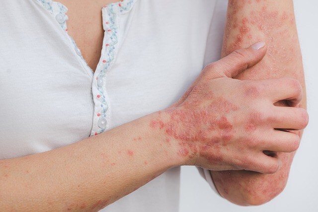 5 Key Nutrients to Help Manage Psoriasis